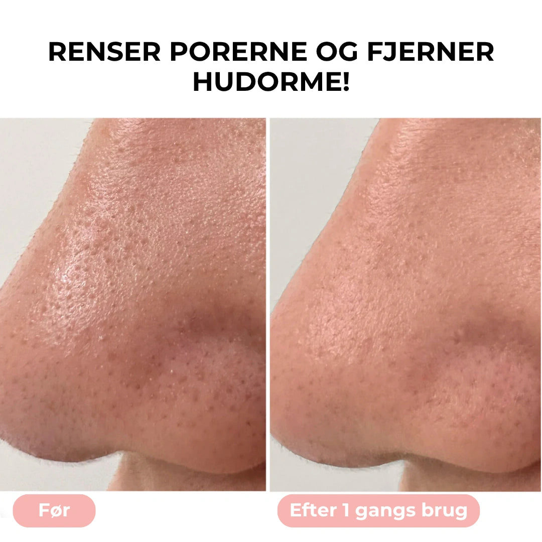 PureGlow - Hudormefjerner med vakuumteknologi