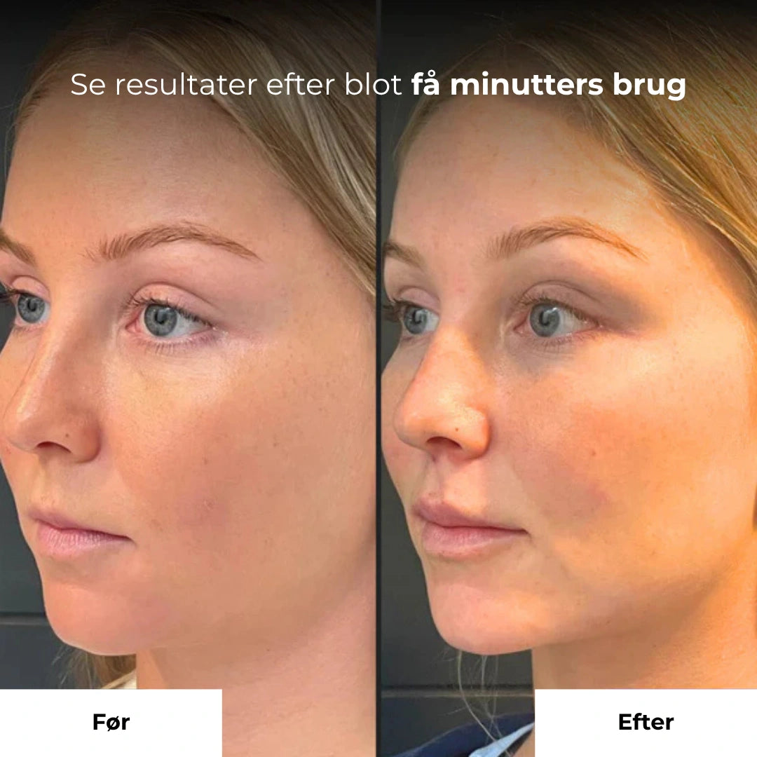ContourPro Roller – Løfter, former & genopliver din hud
